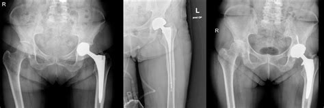 Kurzschäfte in der Revisionschirurgie - Orthopädie & Traumatologie ...