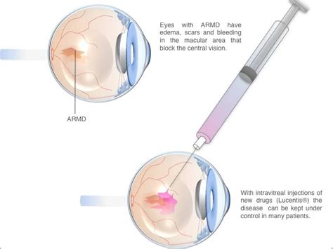Age-Related Macular Degeneration Treatment