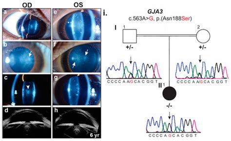 Novel Homozygous Missense Variant in GJA3 Connexin Domain Causing ...