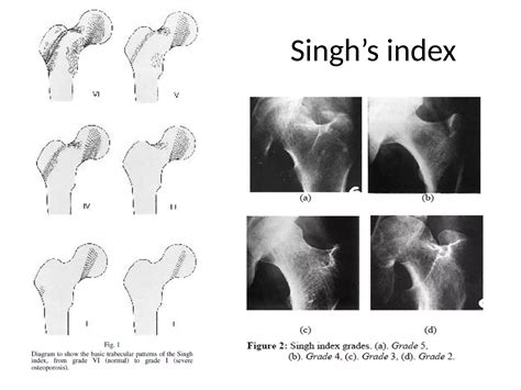 Singh Index Osteoporosis