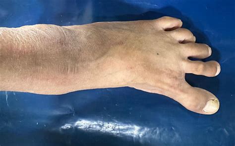 Understanding and Treating Hallux Varus: A Success Story at Kossin Care