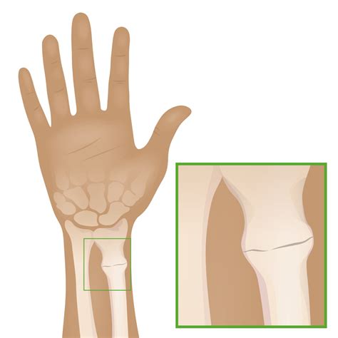 Buckle Fracture Wrist
