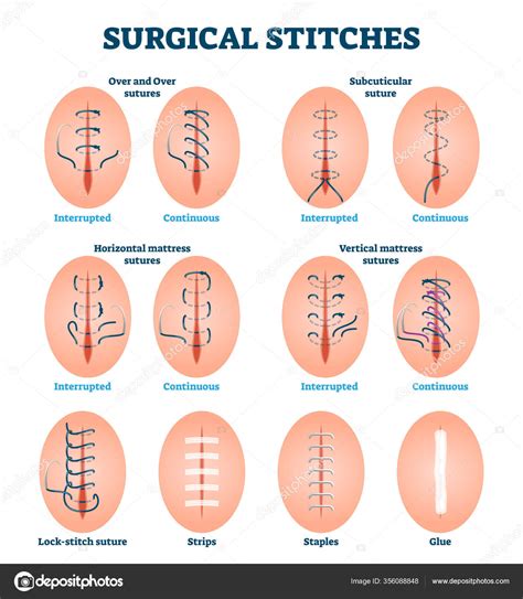 Types Of Surgical Stitches - Free Word Template
