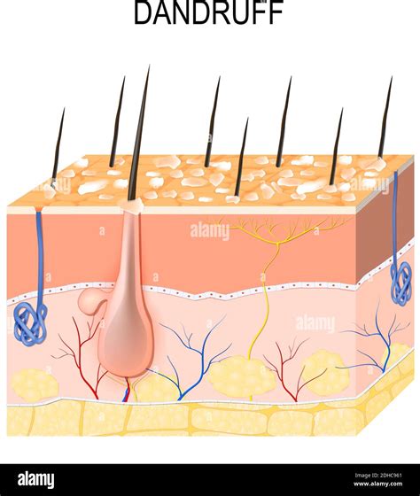 Dandruff Vs Seborrheic Dermatitis