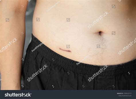 Image result for Appendix Surgery Scar