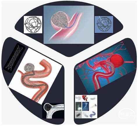 颅内动脉瘤的介入治疗，如何做？ - 脑医汇 - 神外资讯 - 神介资讯