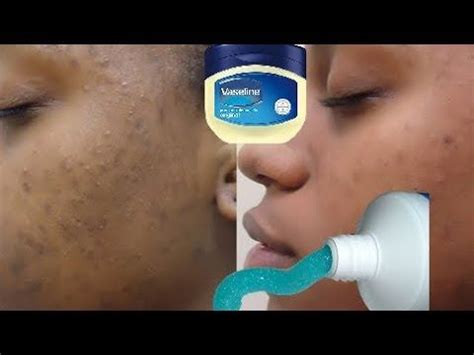 Toothpaste On Dark Spots 的图像结果