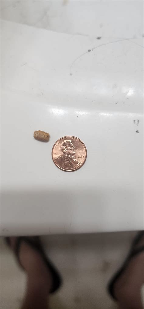 White floaters in urine : r/KidneyStones