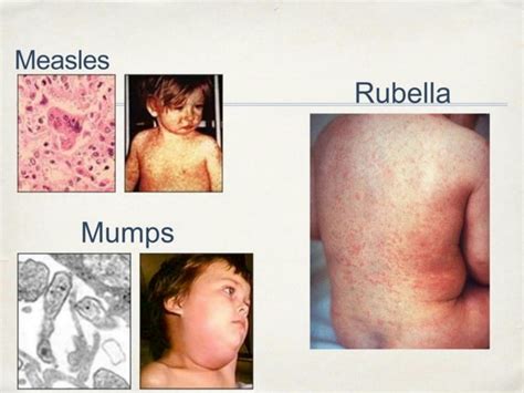 SOLUTION: Measles mumps and rubella presentation - Studypool
