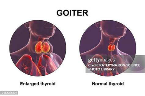 Image result for Thyroid Function Algorithm