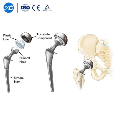 Orthopedic Prosthesis Implant Artificial Hip and Knee Joint Replacement ...