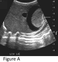 A congenital liver mass | Pediatric Oncall Journal