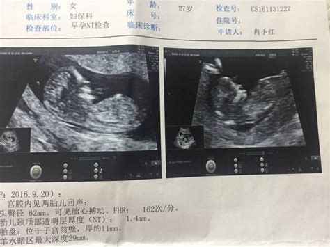怀孕12周NT检查不过关，能说明一定是唐氏儿吗？孩子能不能要_腾讯新闻