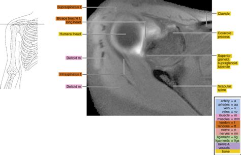 Mr Arthrogram Shoulder 的图像结果