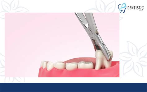 Image result for Tooth Extraction Day 2