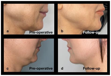 “Ozempic Face”: An Emerging Drug-Related Aesthetic Concern and Its ...