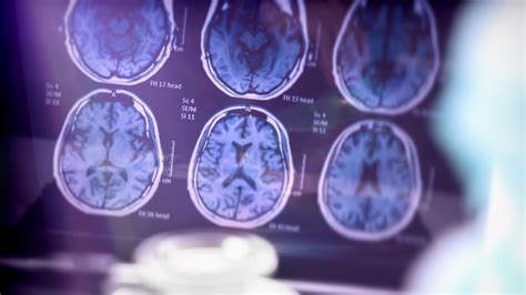 India Gets Its First Non-Invasive FDA-Approved Test for Alzheimer’s ...