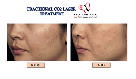 Fractional Co2 Laser - Scars Removal - Laser Treatment - Aesthetic Clinic