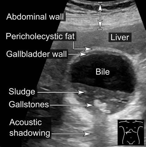MEDICAL ULTRASOUND/GALL BLADDER STONE