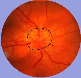 Can Lamina Cribrosa Indicate Optic Neuritis in Multiple Sclerosis?