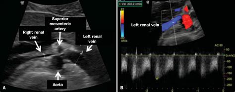 Nutcracker Syndrome Renal Vein Ultrasound at Rochelle Benitez blog