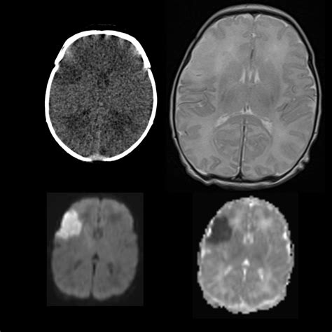 Pediatric Acute Ischemic Stroke | Pediatric Radiology Reference Article ...