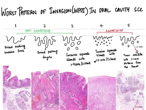 Pathology MCQs | Worst pattern of invasion in Oral cavity squamous cell carcinomas (OSCC ...
