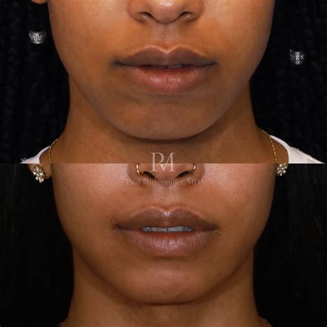 Facial Feminization Surgery Before and After with Osseous Genioplasty and Jaw Contouring ...