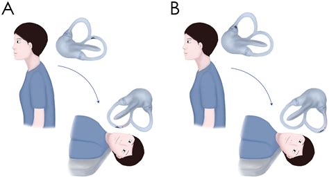Less talked variants of benign paroxysmal positional vertigo - Journal of the Neurological Sciences