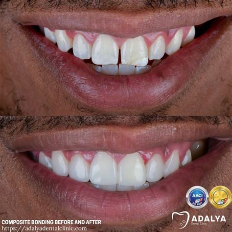 Composite Bonding Before and After - Adalya Dental Clinic