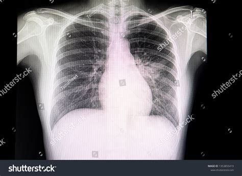 Chest Xray Film Patient Pneumonia Pneumonitis Stock Photo (Edit Now) 1353855419
