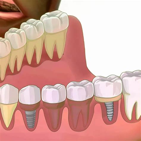 Injertos óseos Implantes dentales
