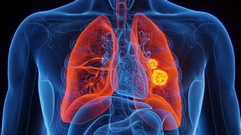Advanced test predicts ALK inhibitor success in lung cancer - Drug ...
