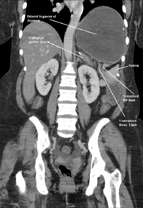 Normal Anatomy Ct Scan Abdomen at Chad Fitzpatrick blog