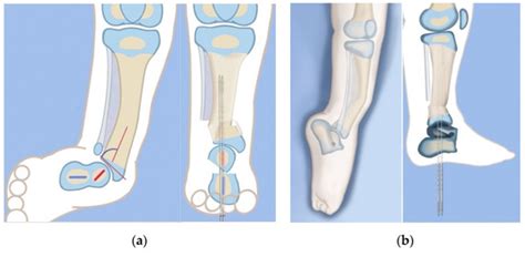 Lengthening Reconstruction Surgery for Fibular Hemimelia: A Review