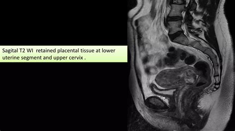 Retained products of conception dr.mohamed Soliman | PDF