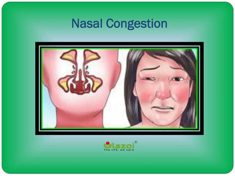 Nasal Congestion Medical Definition at Ronald Lockett blog
