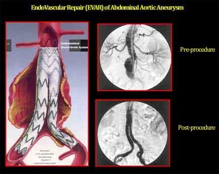 Division of Vascular Surgery - Sree Chitra Tirunal Institute for ...
