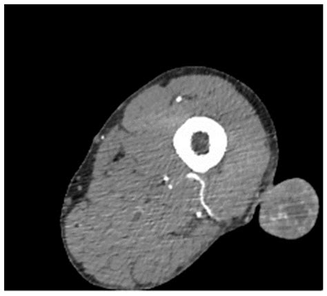 Glomangioma Supply from Profunda Femoris Artery in Peripheral Artery Disease