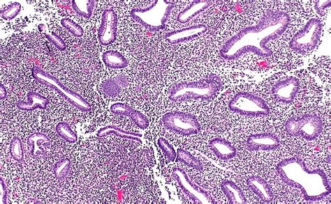 Image result for Disordered Proliferative Endometrium