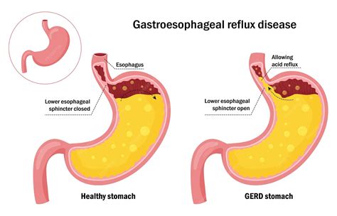 Premium Vector | Healthy stomach and gastroesophageal reflux disease infographic