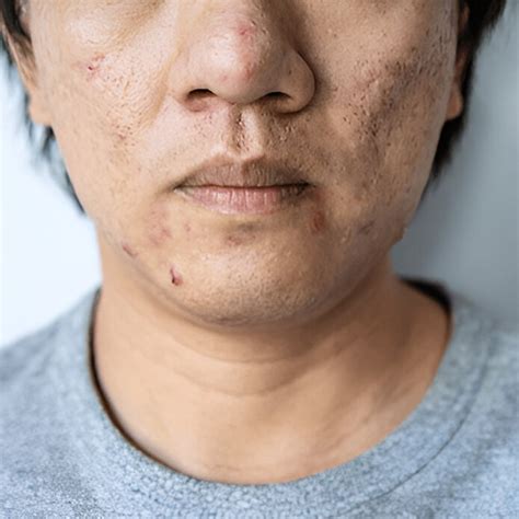 Acne Scars: Types, Causes & Effective Treatments | Wizderm