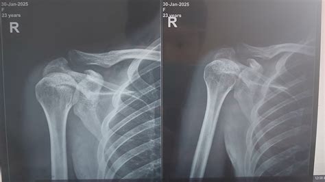 X Ray Normal Shoulder Normal Shoulder, X Ray #3 Shower Curtain By