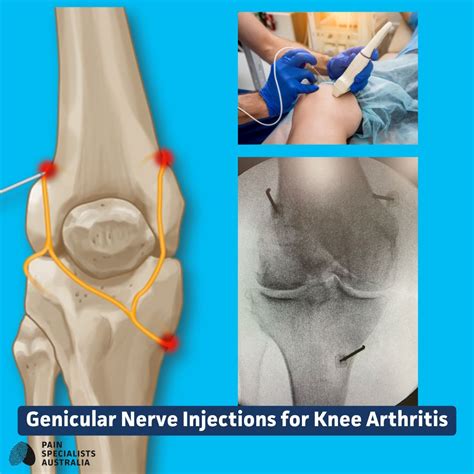 How long does genicular nerve block last? | Pain Specialists Australia ...