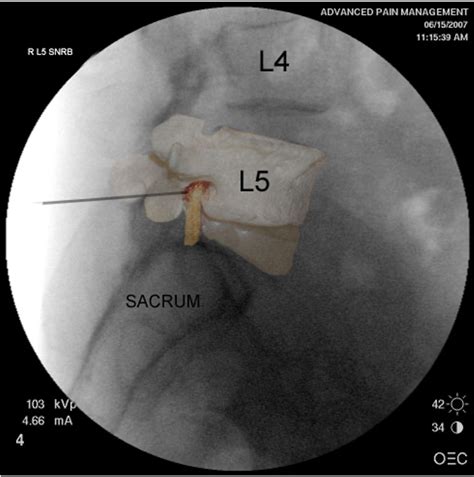 Image result for Nerve Root Block Lower Back