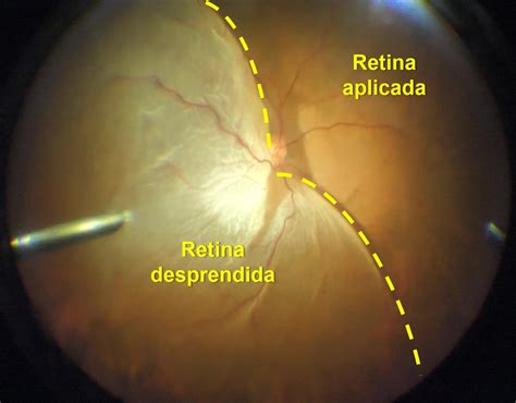 ¿Qué es y cómo se trata un desprendimiento de retina? | Cirugía - Dr. Jeremías Galletti ...