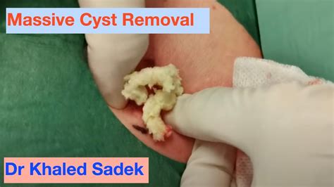 Largest Exploding Cyst 的图像结果