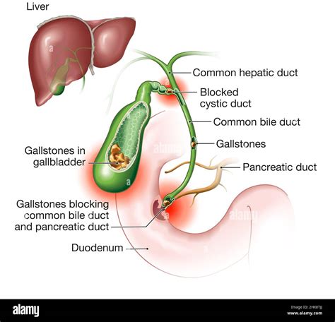 Blocked Bile Duct Symptoms at Bessie Luce blog