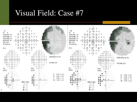 Image result for Visual Field Screen