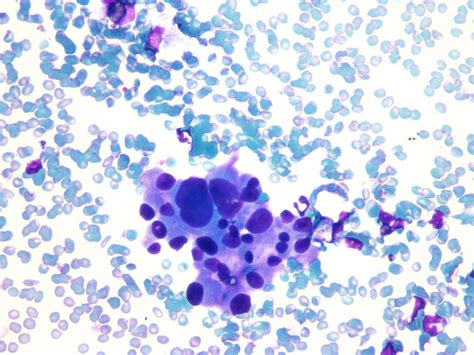 Thyroid FNA – Saudi Society of Cytotechnology and Histotechnology